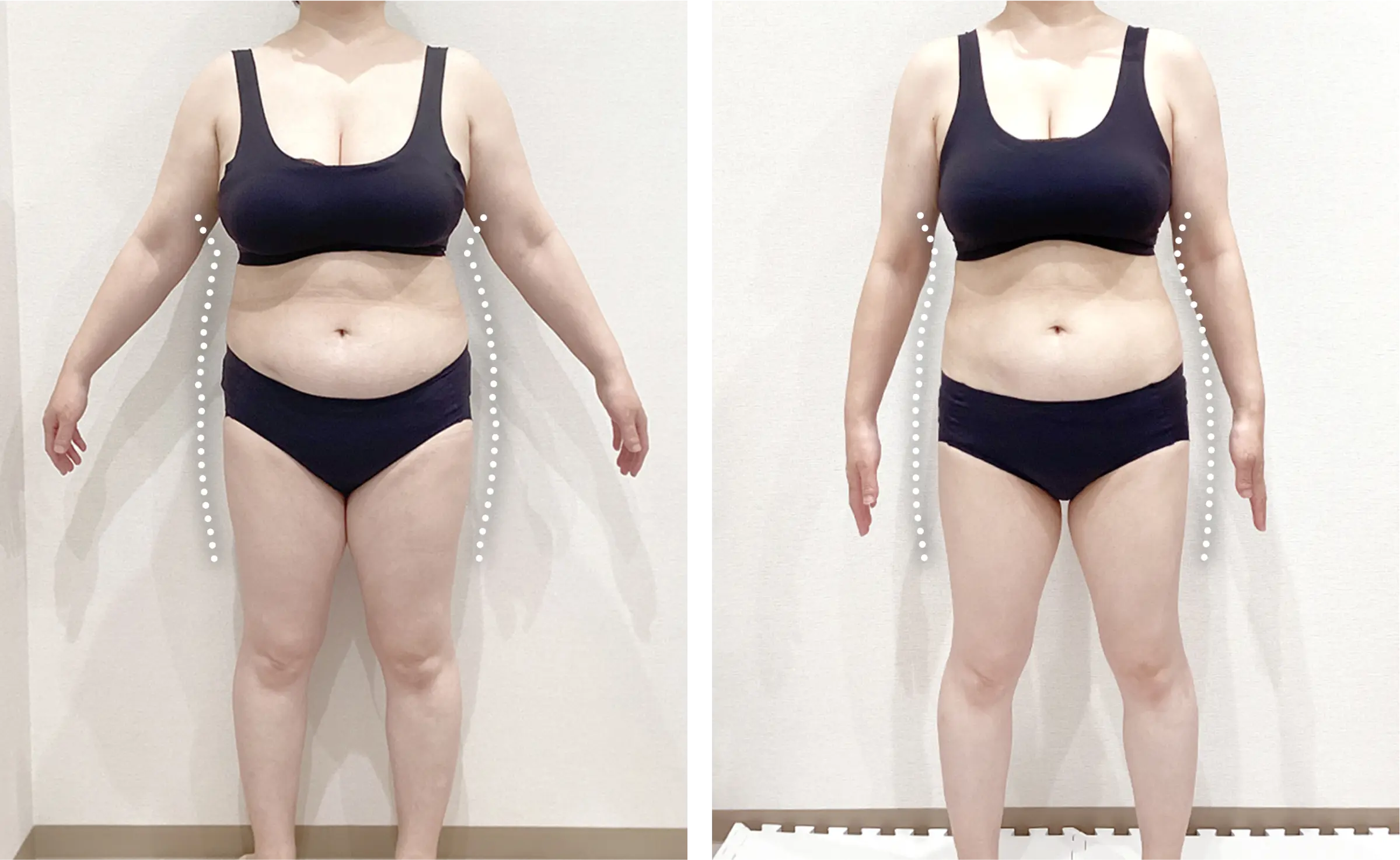 医療ダイエット症例:2カ月で68.8kg→61.4kg（160cm・20代女性）｜エミ