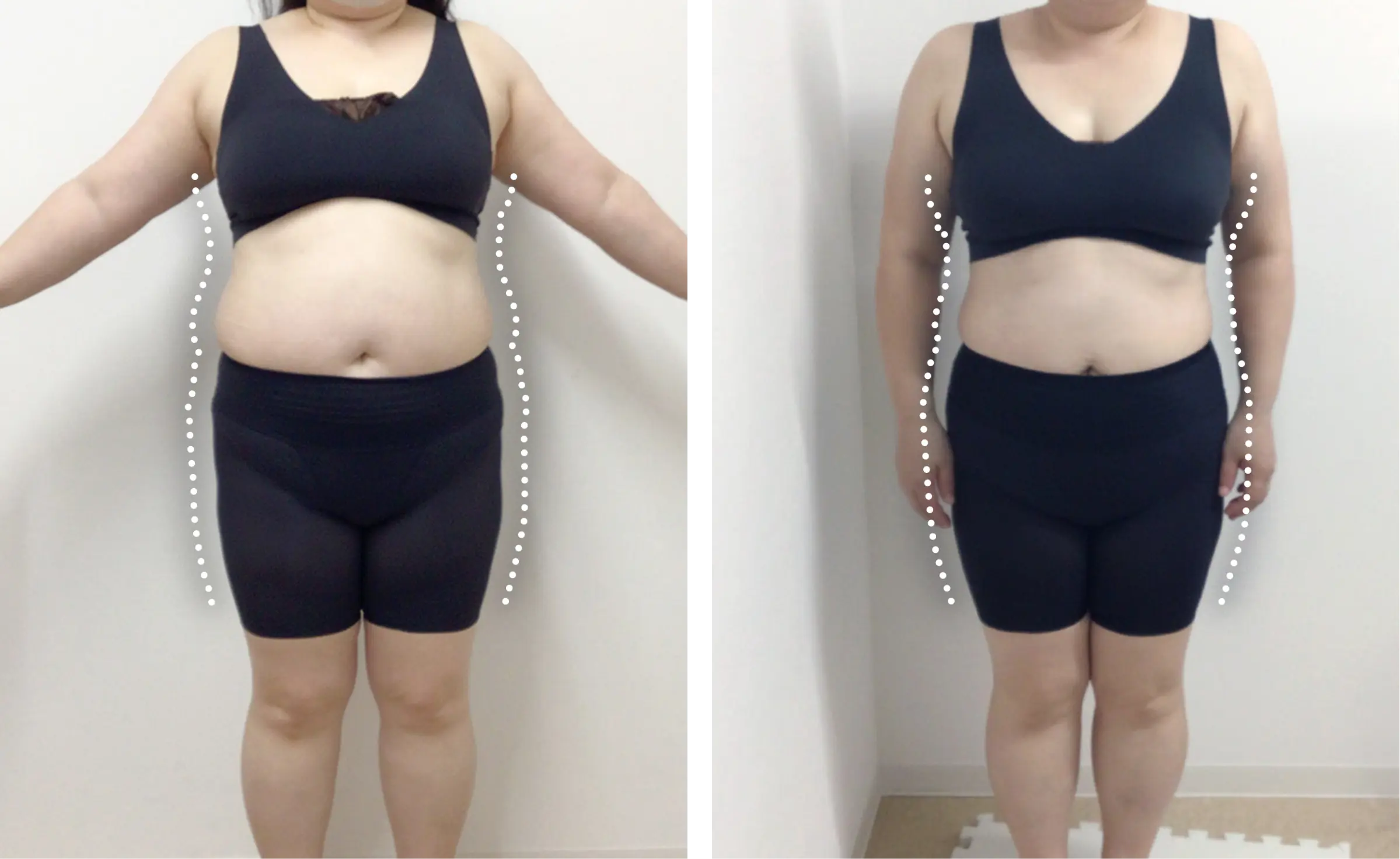 医療ダイエット症例:3カ月で77.5kg→64.4kg（164cm・40代女性）｜エミ