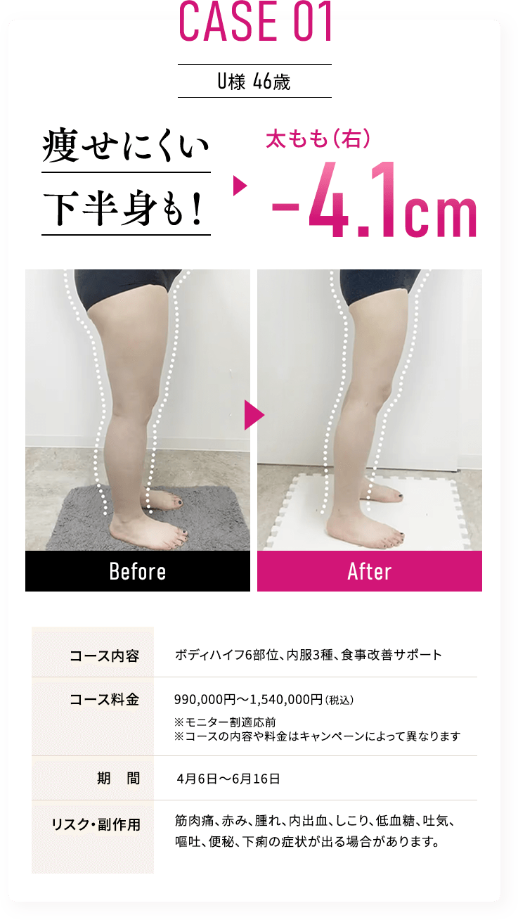 CASE 01 U様 46歳 痩せにくい下半身も！太もも（右）-4.1cm
