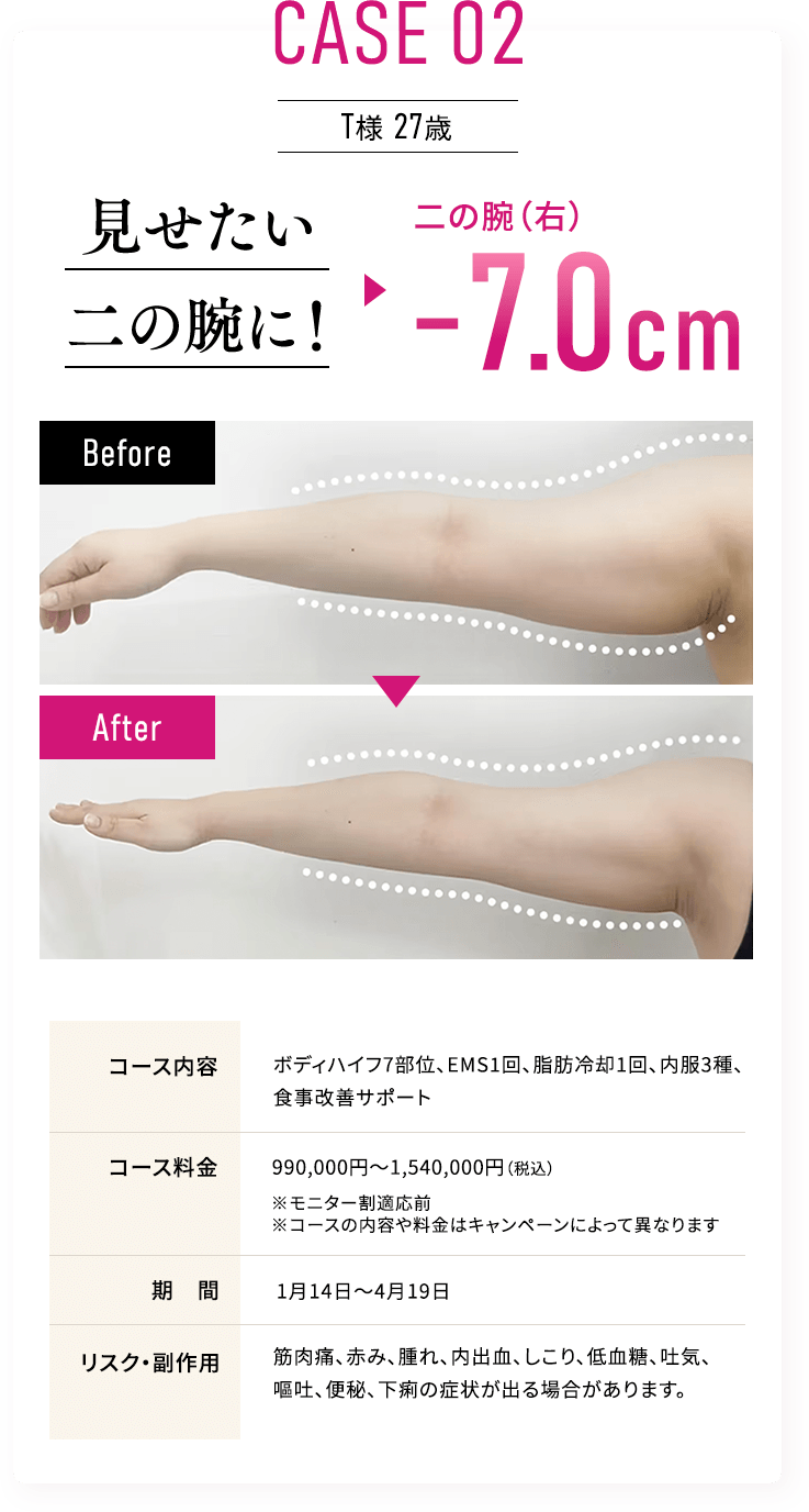 CASE 02 T様 27歳 見せたい 二の腕に！二の腕（右）-7.0cm
